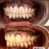 Blanchiment dentaire - Cas 7